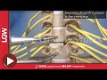 Anterior Cervical Discectomy & Fusion C6-7 3D Surgery Animation