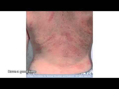 hives pictures
