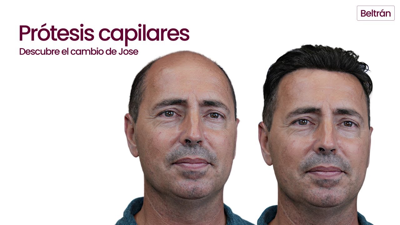 PRÓTESIS CAPILAR A MEDIDA PARA HOMBRE | Conoce a Jose | Alopecia Androgética