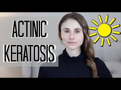 Actinic keratosis removal, treatments, and prevention| Dr Dray