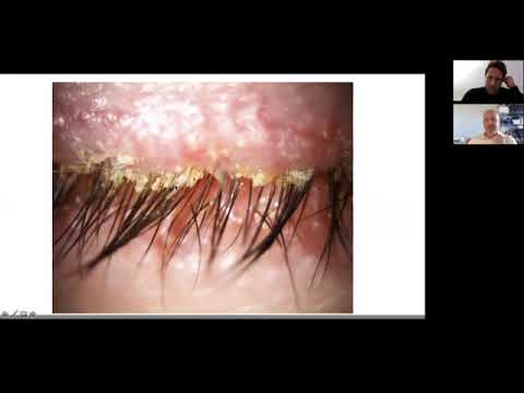 Demodex, l'acaro delle ciglia