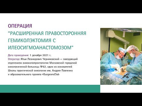Расширенная правосторонняя гемиколэктомия с илеосигмоанастомозом | И.Л. Черниковский