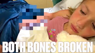 SEVEN-YEAR-OLD BREAKS BOTH BONES IN HER RIGHT ARM ON THE FIRST DAY OF SUMMER BREAK | BOTH ARM BONES