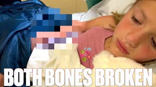 SEVENYEAROLD BREAKS BOTH BONES IN HER RIGHT ARM ON THE FIRST DAY OF SUMMER BREAK | BOTH ARM BONES