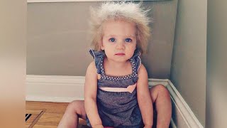 What Is Causing Child’s Uncombable Hair Syndrome