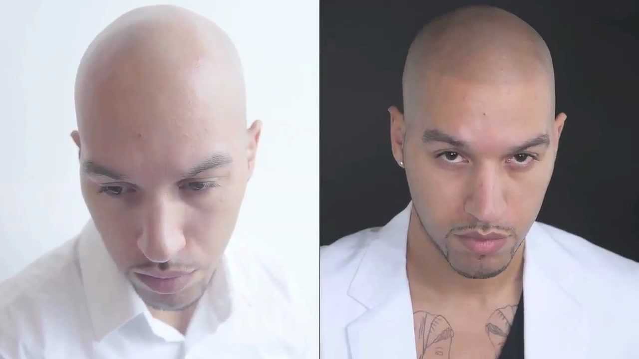 Celebrity Hairdresser Daniel Johnson Gets Scalp Pigmentation Done