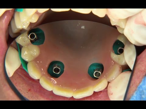 Video: All-on-4 Implantation In The Absence Of Teeth