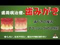 歯周病治療の歯みがき