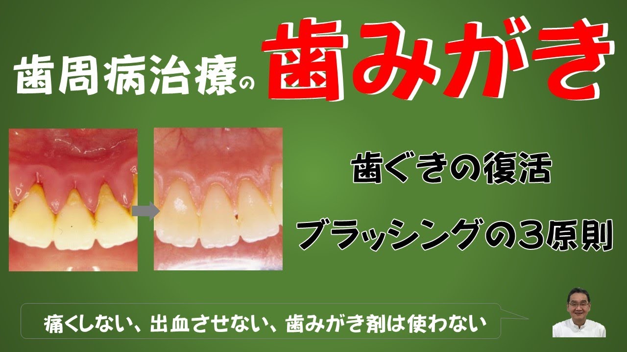 歯周病治療の歯みがき