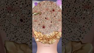 ASMR Giant hardened flakes dandruff removal at hairline |Relaxing ASMR |#asmr #viral #head  #shorts