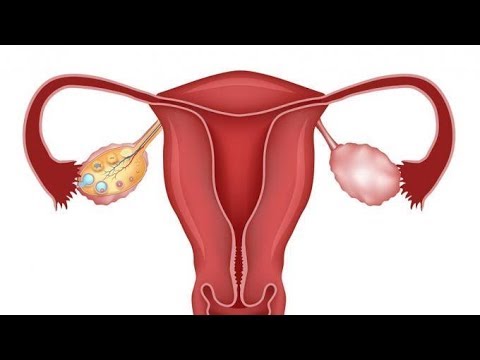 ✅ Jak mięśniaki macicy wpływają na ciążę? Zobacz, co trzeba wiedzieć!