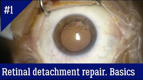 The general principles of vitrectomy for retinal detachment repair