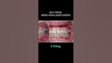 Hành trình 24 tháng niềng răng #braces #dentist