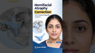 Hemifacial Atrophy Correction with Patient-Specific Implant #Shorts