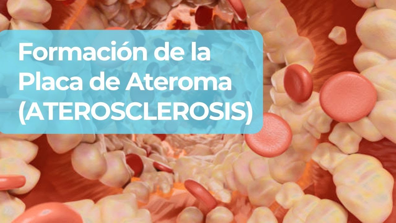 Glucemia Elevada y Placa de Ateroma: ¿Cuál es la Conexión?