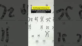 Abnormal Karyotype Part 6