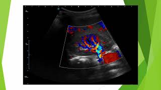 Le pic systolique précoce en doppler rénal (lobulaire)