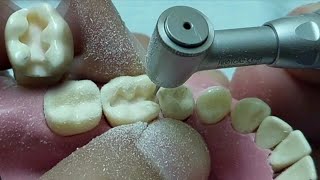 تريكات ال cavity preparation وازاى تجهز كلاس ٢ بكل سهوله_Class II amalgam preparation
