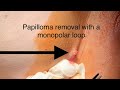 Papilloma Removal