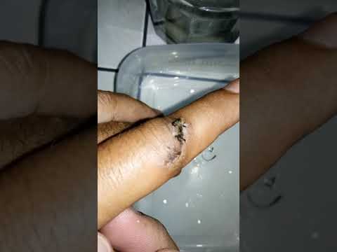 Cara Mencabut Sendiri Benang Bekas Luka Jahitan Pada Jari Tangan Youtube
