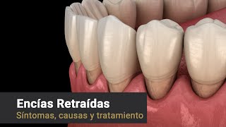 Provenza Clínica Dental  Encías Retraídas; Síntomas, Causas y Tratamiento
