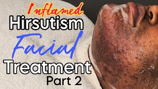 Inflamed Hirsutism Session Part 2 Facial Treatment //Let's Soothe Her Skin!