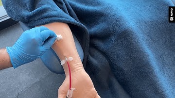 iMEP Tips & Tricks 31: Buttonhole Technique Preventing Infection During Cannulation