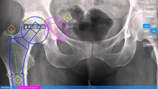 Orthopedic Surgery 2D Planner
