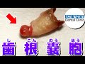 歯根嚢胞(しこんのうほう)[Root cyst]牙根囊肿