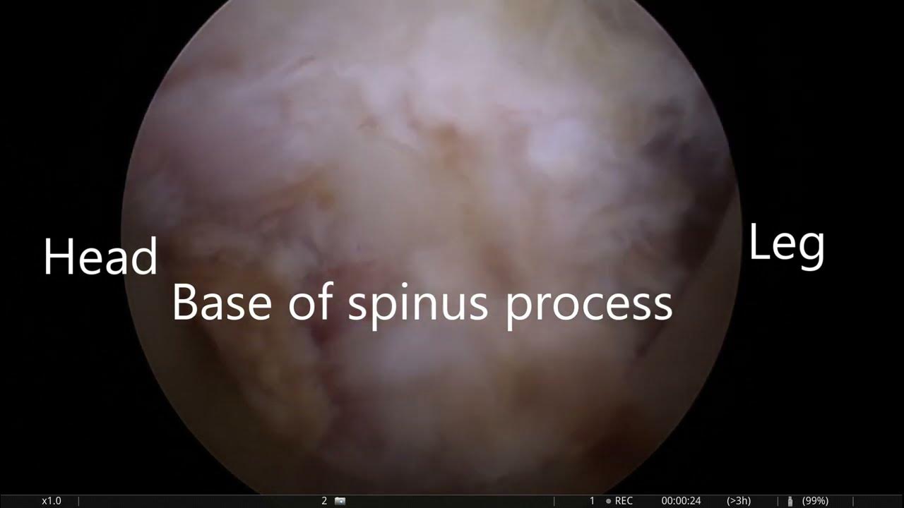 Interlaminar contralateral endoscopic lumbar foraminal L5