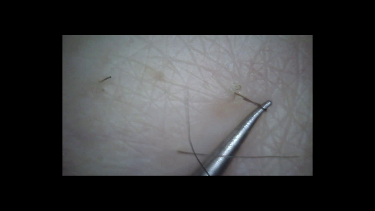 Ingrown Hair Released YouTube