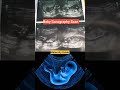 Baby Sonography Scan Viral Trending Youtube Baby Pregnancy
