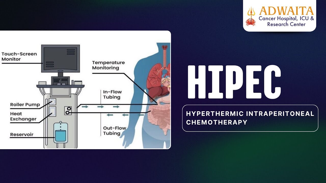 Advanced HIPEC Procedure Explained | Heated Chemotherapy by Dr. Divyesh Pathak