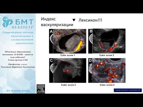 Объемные образования яичников. O-RADS с точки зрения УЗИ