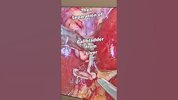 See Marvel of modern science ? Laparoscopic cholecystectomy is Gallbladder Removal operation