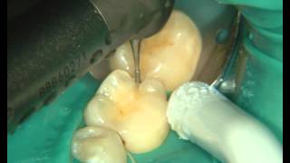 Лечение кариеса боковых зубов (материал Capo Natural)(Лечение кариеса на молярах нижней челюсти с помощью нанокомпозитного материала Capo Naturals (Schutz Dental). Все видео..., 2015-12-01T04:49:41.000Z)