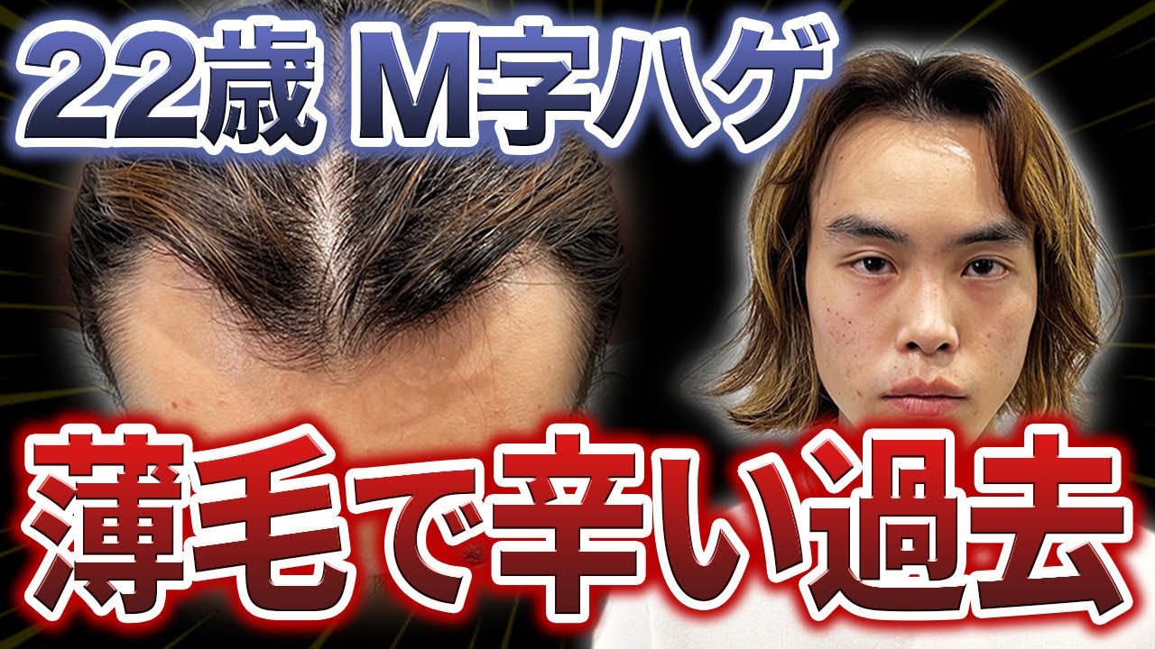 若年性M字ハゲ 総額公開】M字ハゲだけを確実に改善するAGA治療！ - 湘南AGAクリニック