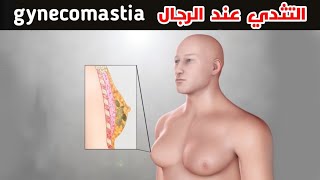 التثدي عند الرجال (الاعراض -الاسباب-العلاج) _ men chest enlargement (gynecomastia)