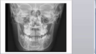 Basic Radiology of the Skull