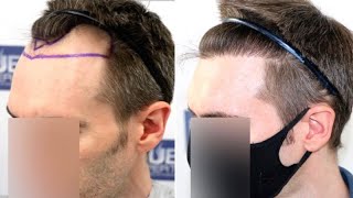 FUE Hair Transplant (1500 Grafts NW III A) By Dr Juan Couto - FUEXPERT CLINIC, Madrid, Spain