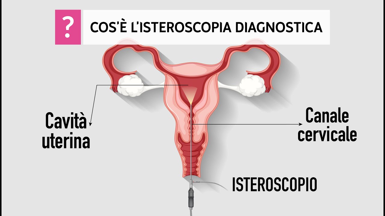 Isteroscopia diagnostica, cos’è, quando è indicata e come si esegue