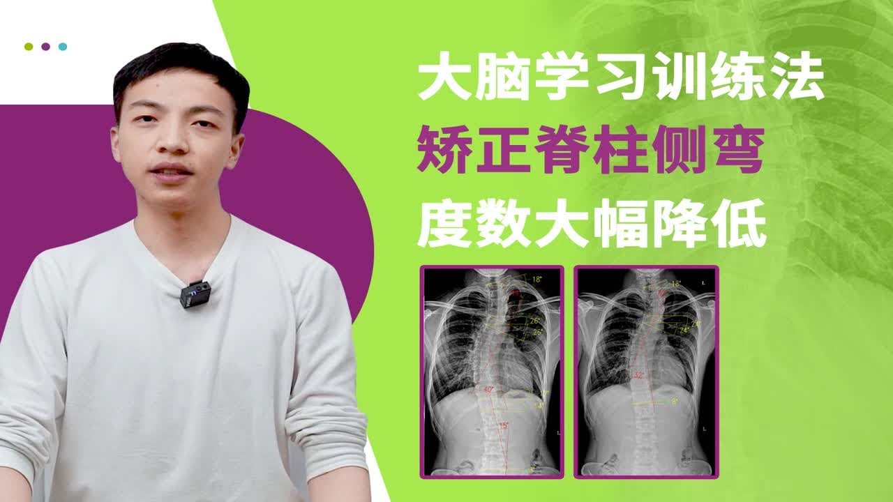 23岁脊柱侧弯,成年后仍可以降低度数,剃刀背获得改善。 - YouTube