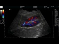 uro SonoFly®MS kidney 192 CFM 2