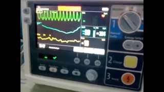 Ventricular Tachycardia in Cardiac Monitor