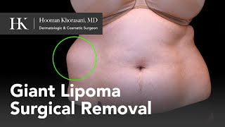 How to Remove a Giant Lipoma of the Abdomen | Dr. Hooman Khorasani