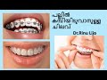 പല്ലിൽ കമ്പിയിടുവാനുള്ള ചിലവ് [Cost of braces] Dr.RinuLijo