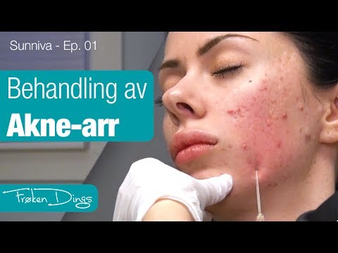 Treatment of Acne scarring