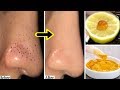 HOW TO REMOVE BLACKHEADS & WHITEHEADS from Nose & Face naturally at home By NaturalBeautyTips