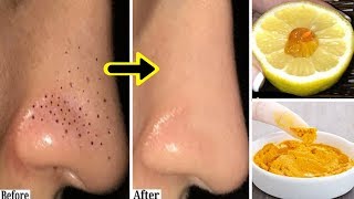 HOW TO REMOVE BLACKHEADS & WHITEHEADS from Nose & Face naturally at home By NaturalBeautyTips