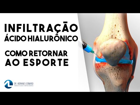 Vídeo: Perguntas E Respostas Dos Especialistas: Noções Sobre Viscosuplementos Para OA Do Joelho